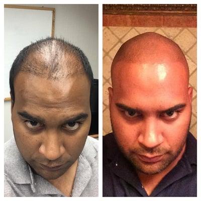 Before and After Scalp Tricopigmentation aka Hair Follicle Replication tattoo.