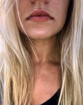 Lip filler