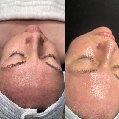 First session of microdermabrasion