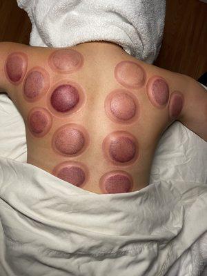 Did you know cupping will help ease muscle tension and leave you feeling with greater range of motion.  Here is a lady who sits long hours