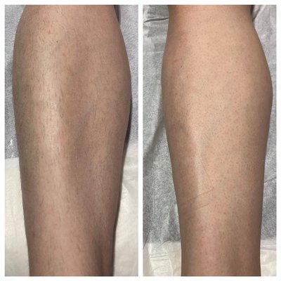 Before and after lower leg wax