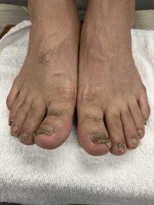 Before dry pedicure