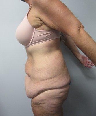 Tummy Tuck Surgery - Before