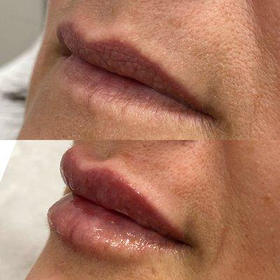 Lip filler by Galena Neal