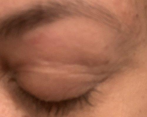 Cut and swollen eye from threading