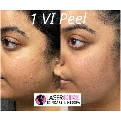 Vi peel for acne