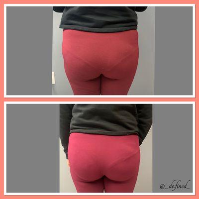 This is the buttocks therapy session and in only one hour we were able to give her booty more definition