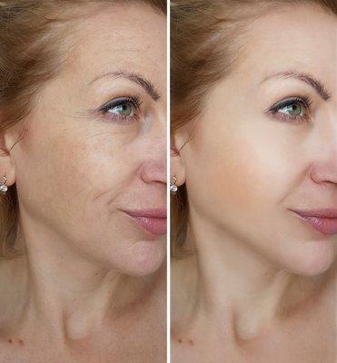 Smooth away fine lines and wrinkles with our expert anti-wrinkle injections.