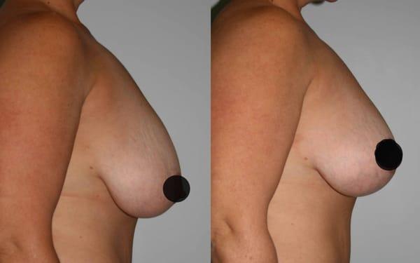 Breast Lift Before and After. Learn more about breast lifts at http://www.drgregpark.com/breast-lift