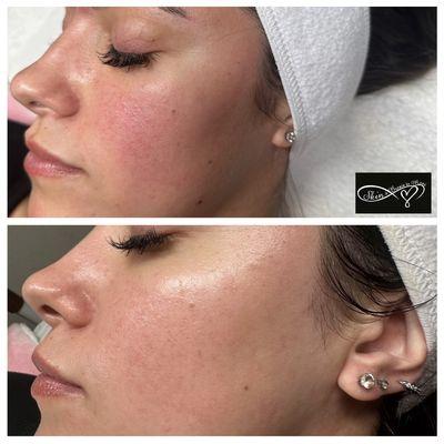 Before & After- 1 Treatment (Dermaplaning Facial)