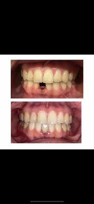 Implant Dentistry