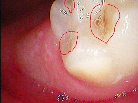 Primary molars of two different patients, 3 years old, with significant decay.....young children should start having dental check ups at 1 y