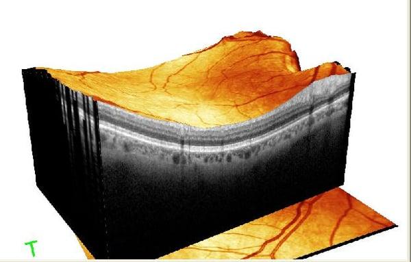 This is a digital photo showing a healthy retina - part of your comprehensive exam.