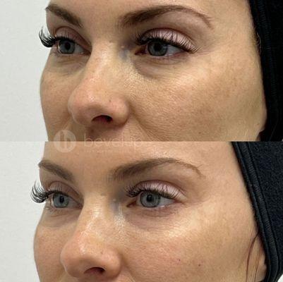 Before and after undereye filler