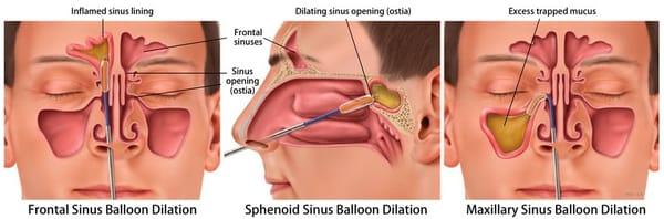 Minimally invasive, in-office sinus surgery is offered at the clinic