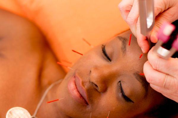 Organic Acupuncture Facial Rejuvenation & Microneedling