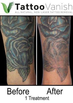 Tatoo Removal One session. No laser