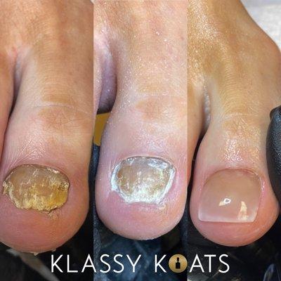 Toenail Restoration with Fungal Toenail Treatment