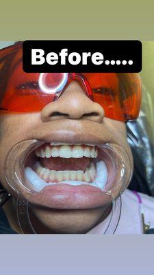 Teeth whitening