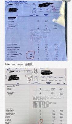 The 44-year-old man had abnormal liver function. After treatment with Chinese medicine, he completely returned to normal.