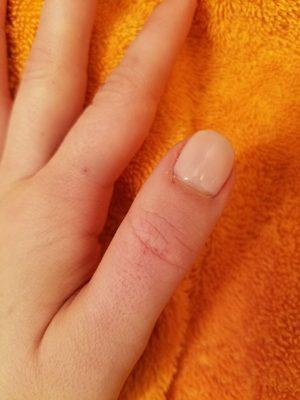 Scrapes on thumb from buffing.