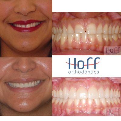 Before and After's of a Hoff Smile!