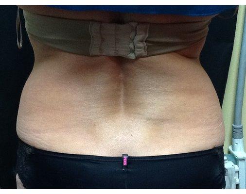 After -CoolSculpting flanks. (8 weeks post treatment)