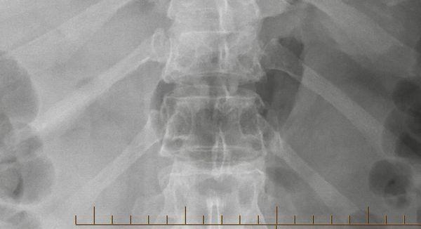 X-ray of anomalous heterogeneous mass with complex internal structures.