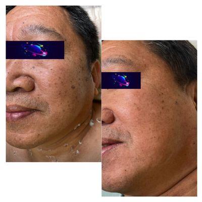 Before and after 1 pigmentation facial treatment. Text your picture at 916 801 9859 for evaluation.