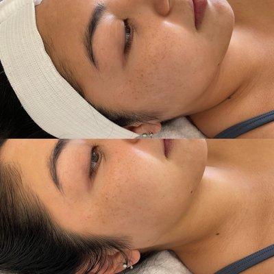 Before and after DERMAPLANING