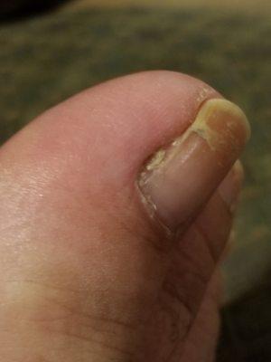 See the jagged piece on the lower left nail, now growing into my toe painfully.