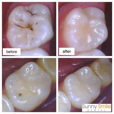 cavities restoration