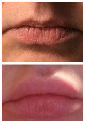 Before and after Versa lipfiller.