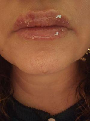 Lip Fillers