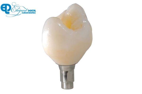 Screw retained Implant Crown