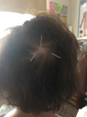 Hair Loss Acupuncture treatment