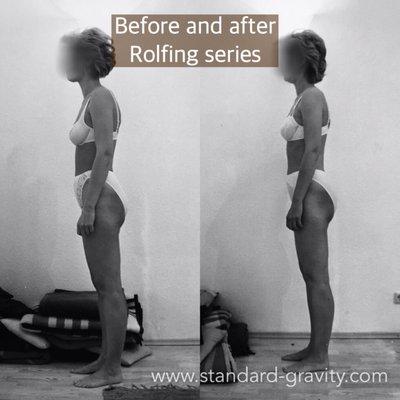 This client had "good" posture, but still improved with Rolfing. The head/neck angle shifted, ensuring better posture with age.