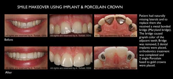 Smile Makeover Using Implant & Porcelain Crown