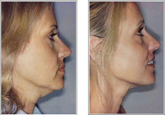 radiofrequency and ultrasound 40 minute treatment for chin fat removal, defining the jaw as well as full face rejuvenation. multiple appts