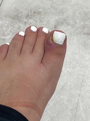 Infected toe mail from a SIMPLE pedicure.