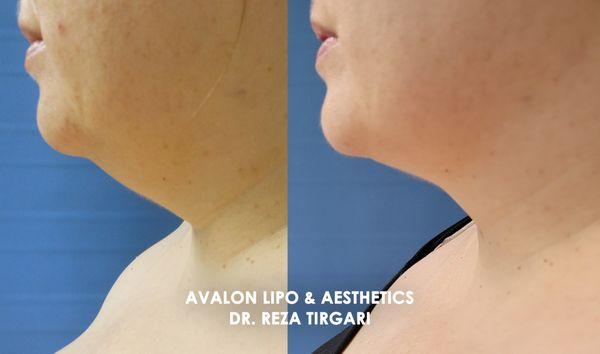 Before & After Liposuction with Dr. Tirgari - www.lipoandaesthetics.com - Neck/Chin