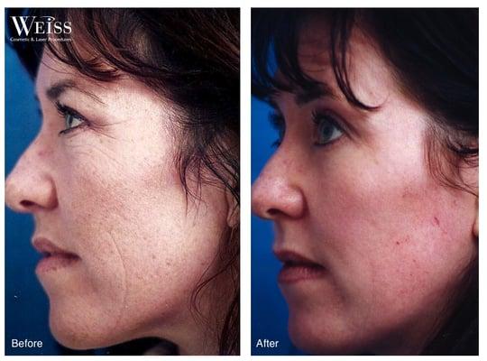 Before and afters of skin rejuvenation treatments