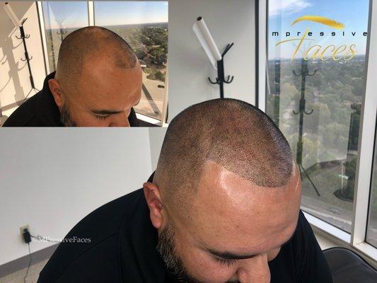 Scalp Micropigmentation