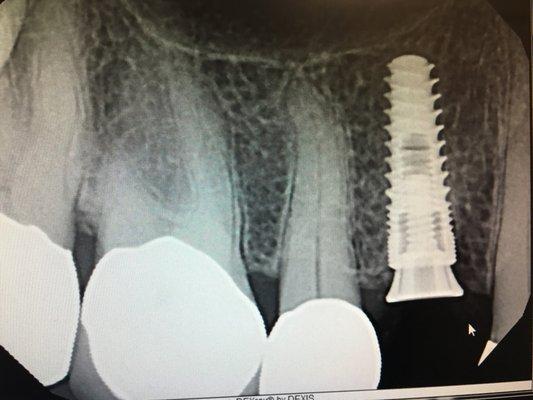 How an implant replaces the root of a tooth