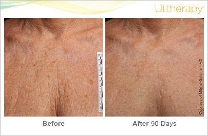 ultherapy decolletage before and after