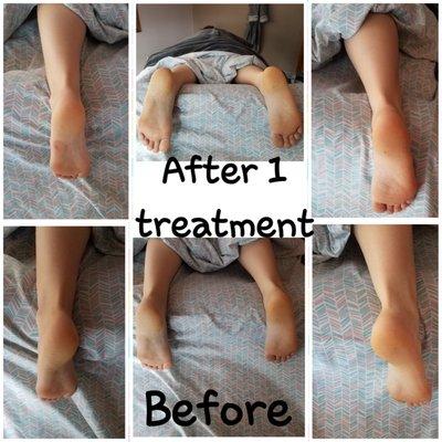 Straightening & lengthening of my feet & calves.