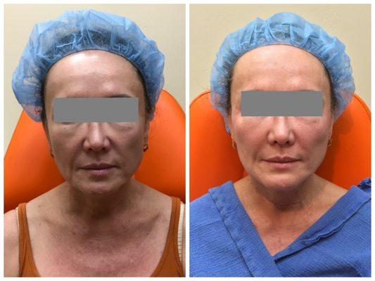 YLift procedure immediate reasults by Yung Chen, MD