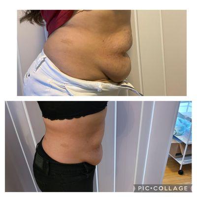 Immediate results, postpartum body treatment!!!