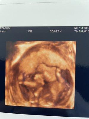 3d ultrasound 17 weeks