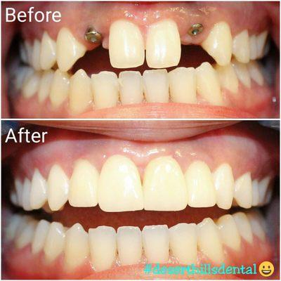 We love what we do because smiles are our thing!  Do you love your smile?  We are here to help in all your cosmetic needs! #veneers #implant